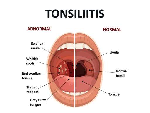 Tonsillitis