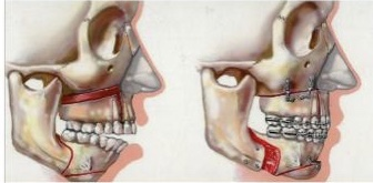 corrective jaw