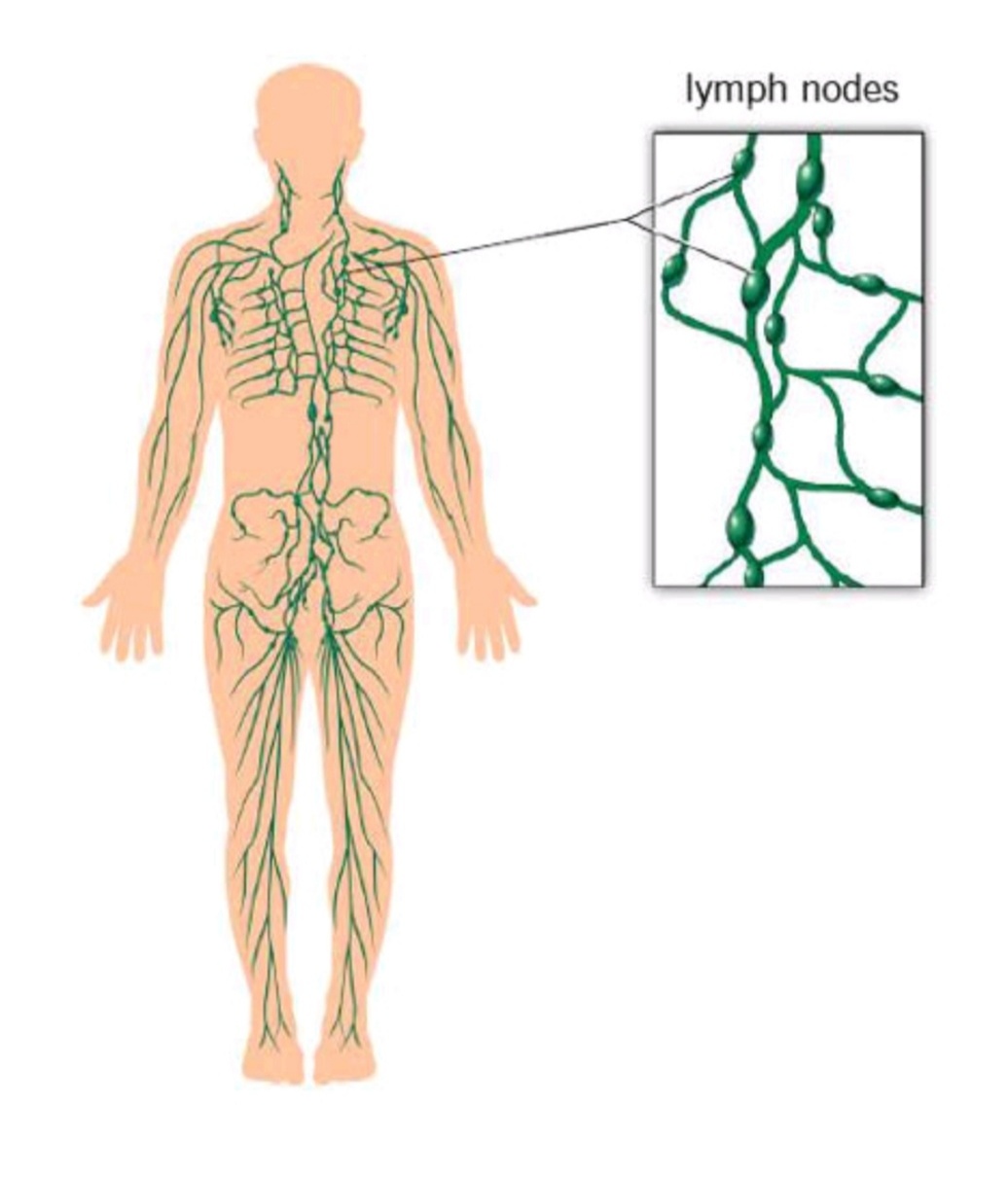 lymphedema