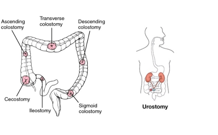 Osotomycare