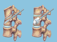 Spine surgery