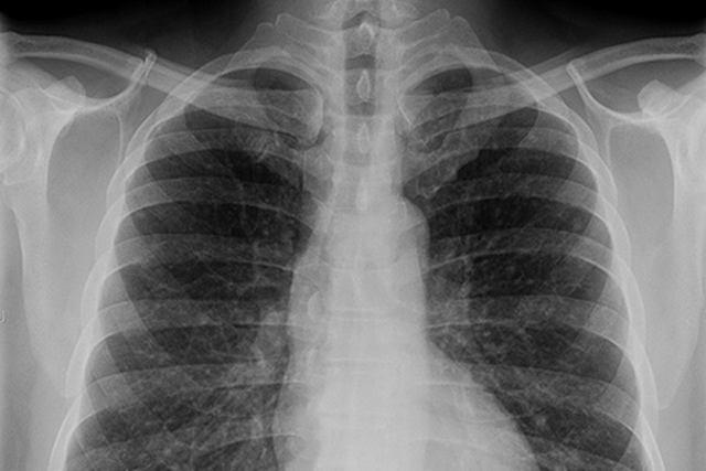 LungCancer.png