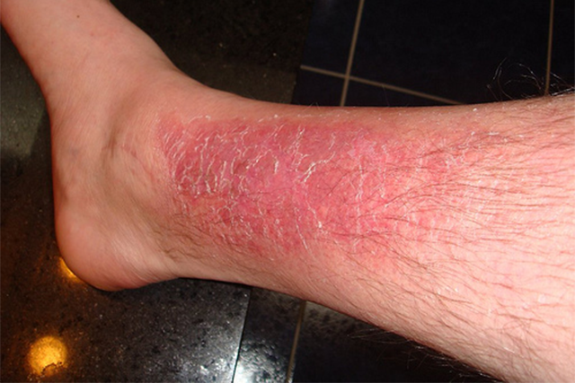 burnskin.png