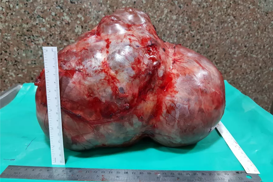7-kg-pancreas-tumor-50-yrs-old-lady-dimensions