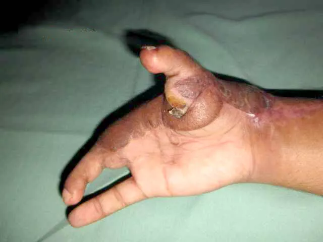 palm-after-sugery-900x600-1