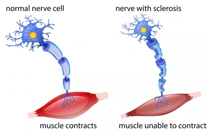 multiple sclerosis symptoms and procedures