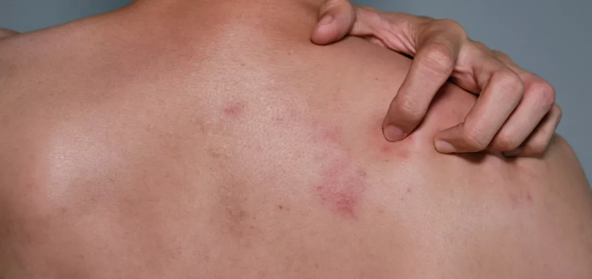 Shingles: Causes, Symptoms, and Treatment