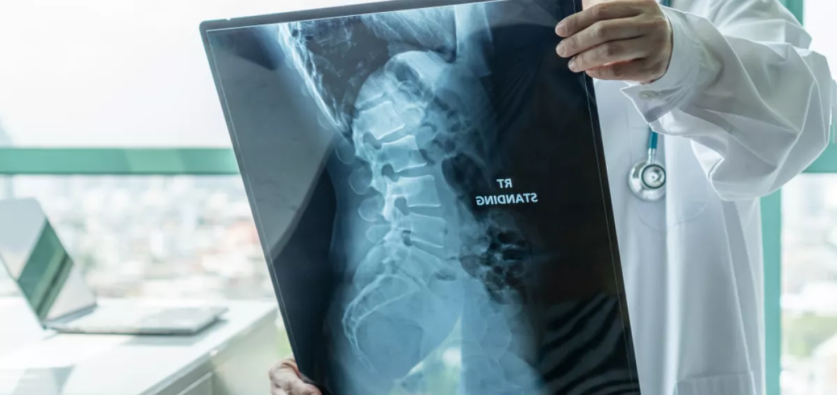 spinal muscular atrophy types