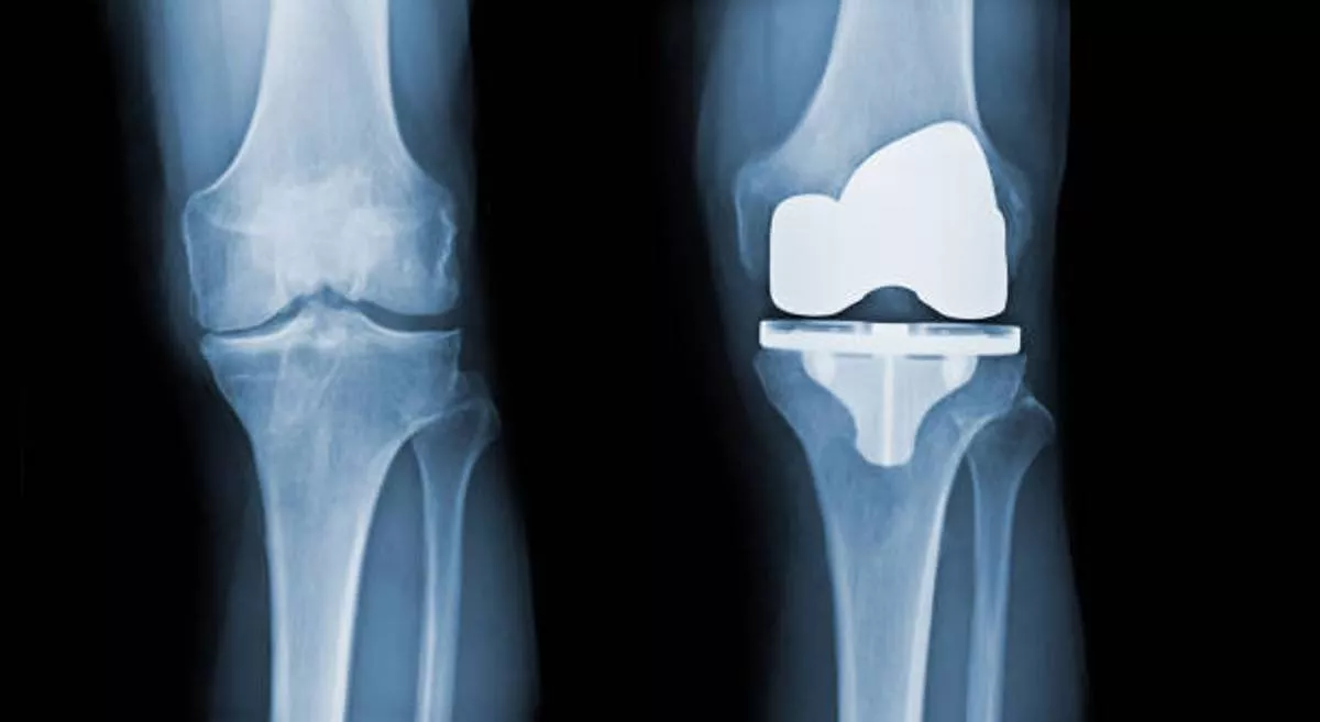 total-knee-replacement-surgery