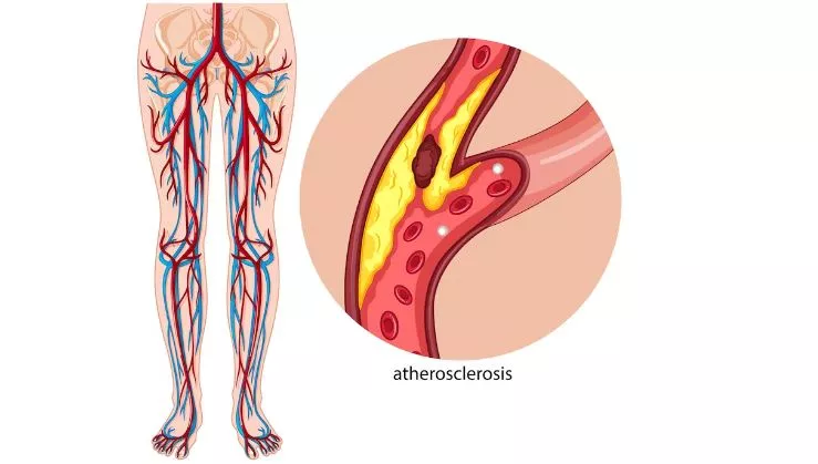 vascular diseases