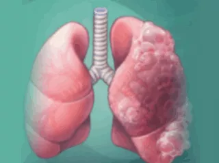 COPD (Chronic obstructive lung disease)
