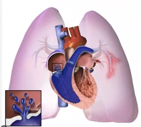 congenital heart disease