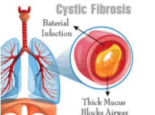 Cystic lung diseases