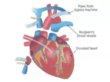 Heart & Double lung transplantation