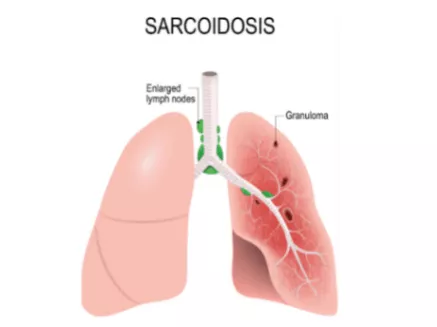 Sarcoidosis