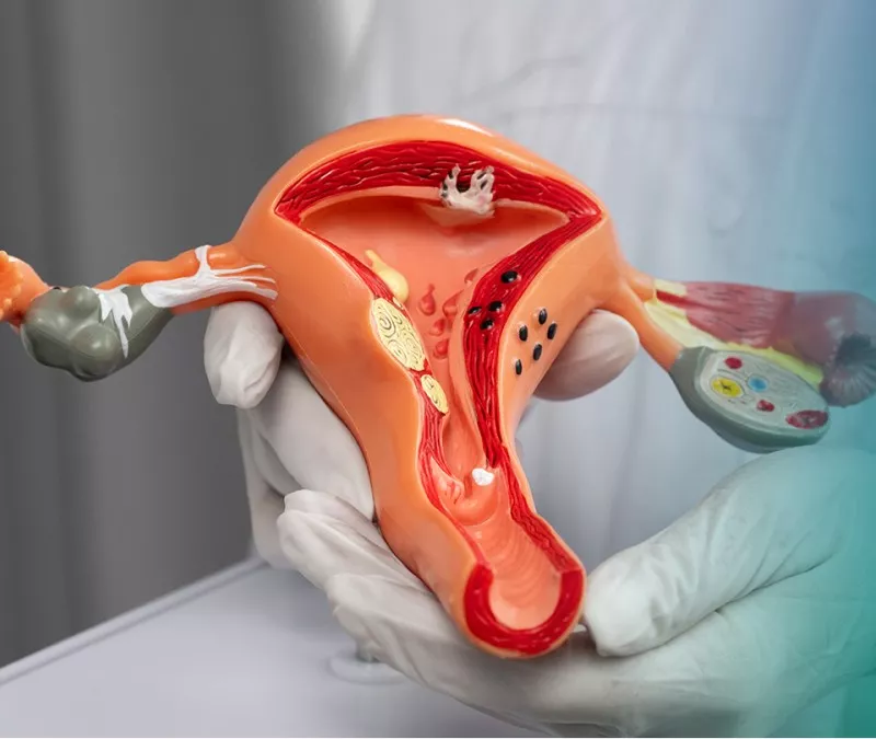 uterine fibroid embolization