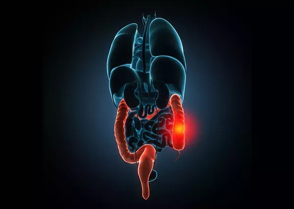 Inflammatory bowel disease