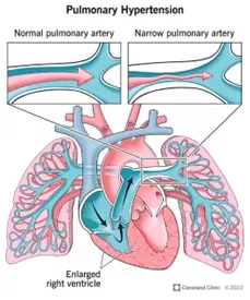 severe pulmonary hypertension