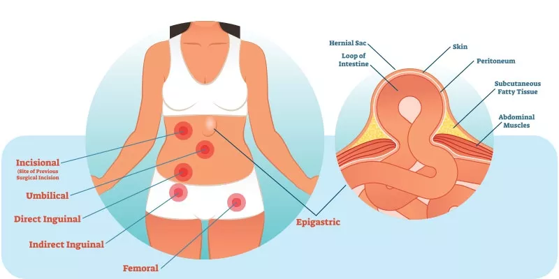 hernia