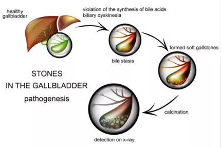 Gallstones