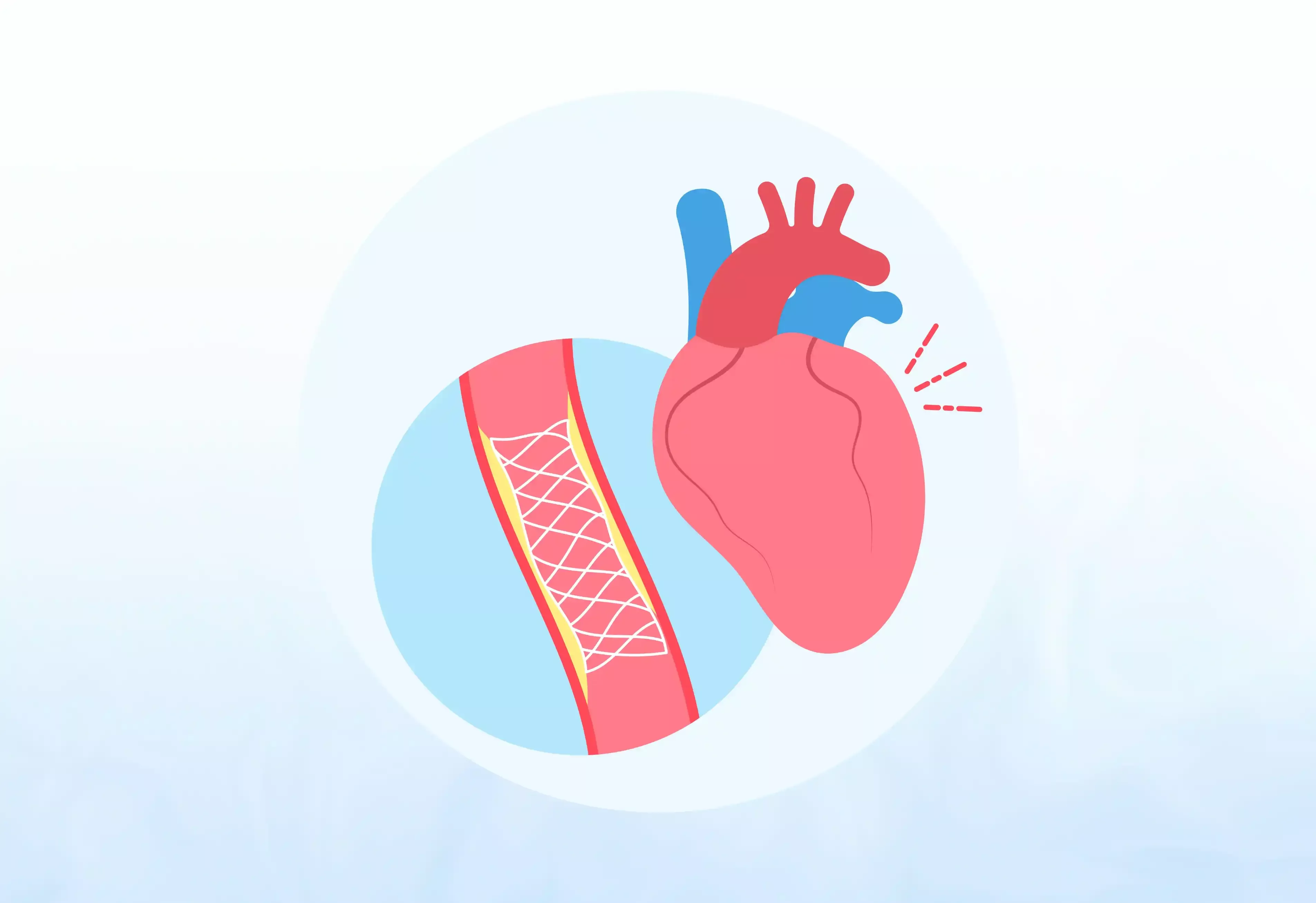 Coronary-and-Heart-Valve-Procedures