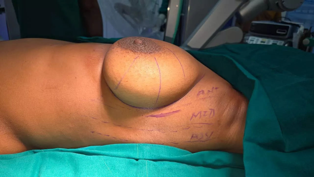 Breast Carcinoma 1