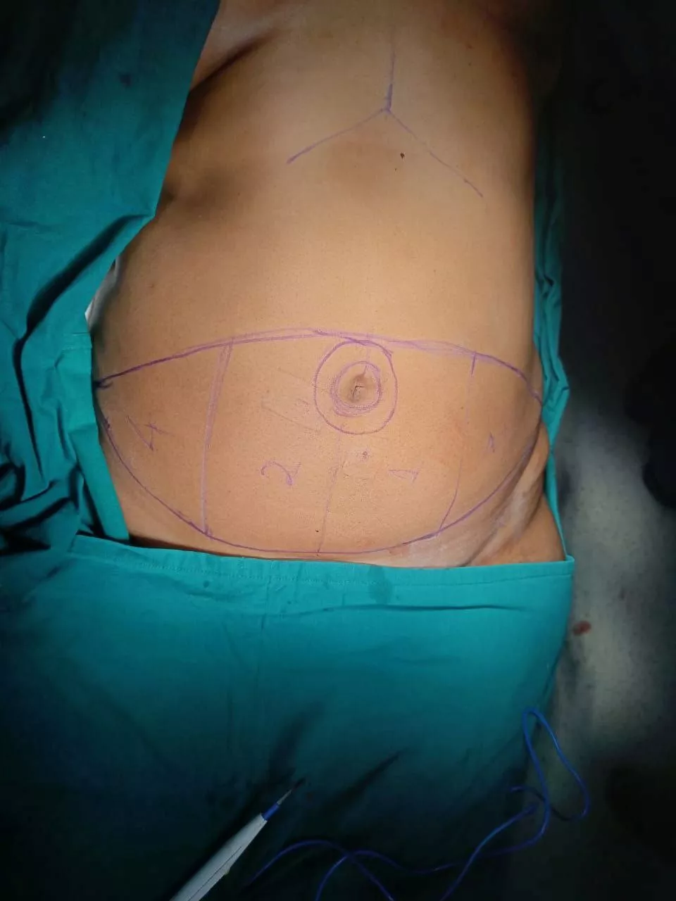Breast Carcinoma 4.1