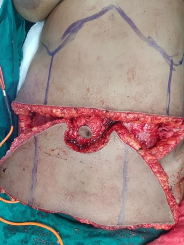 Breast Carcinoma 4.2