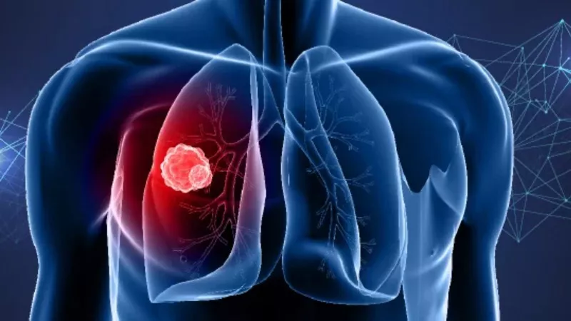 Lung cancer