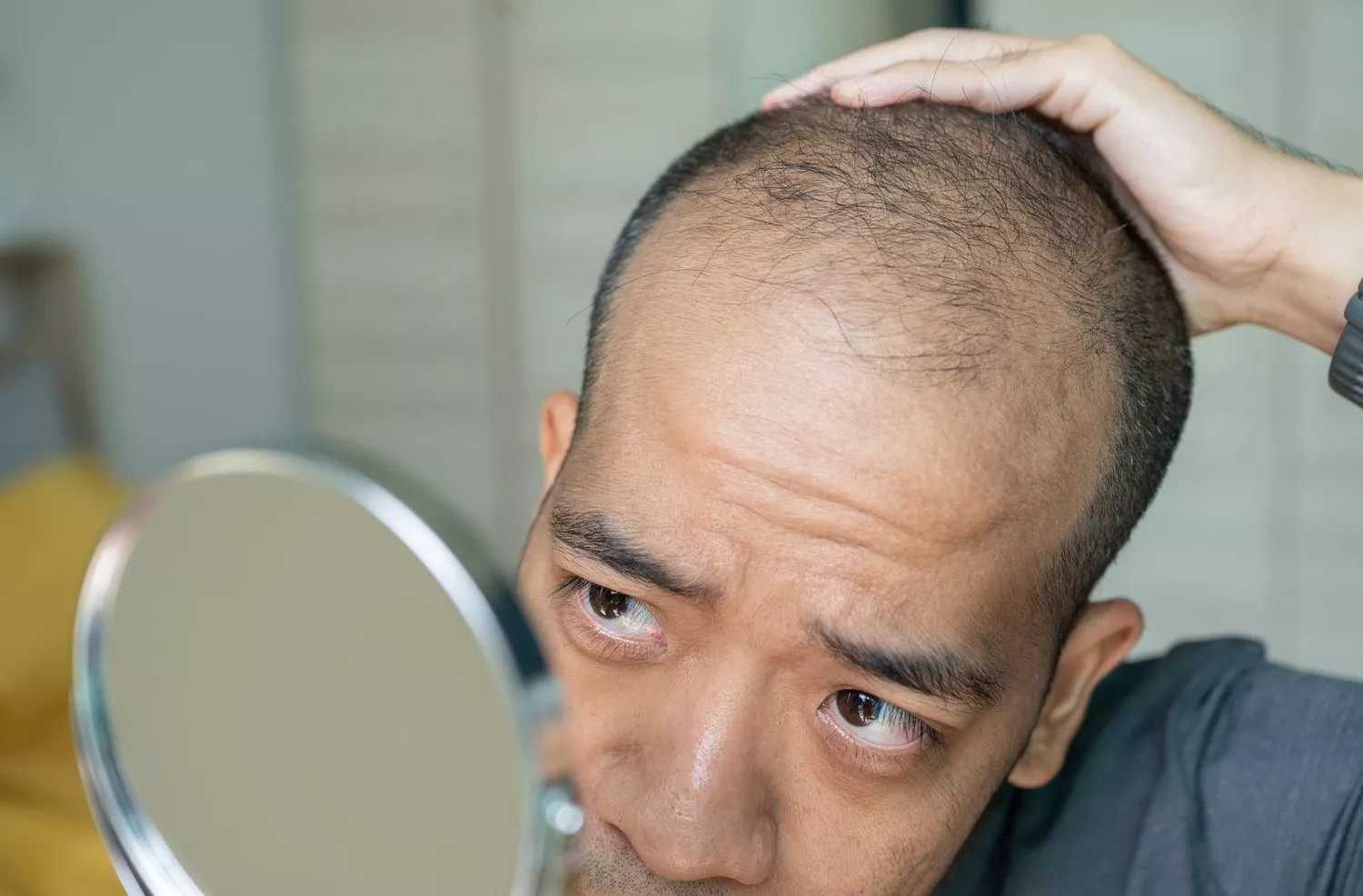 Hair Loss