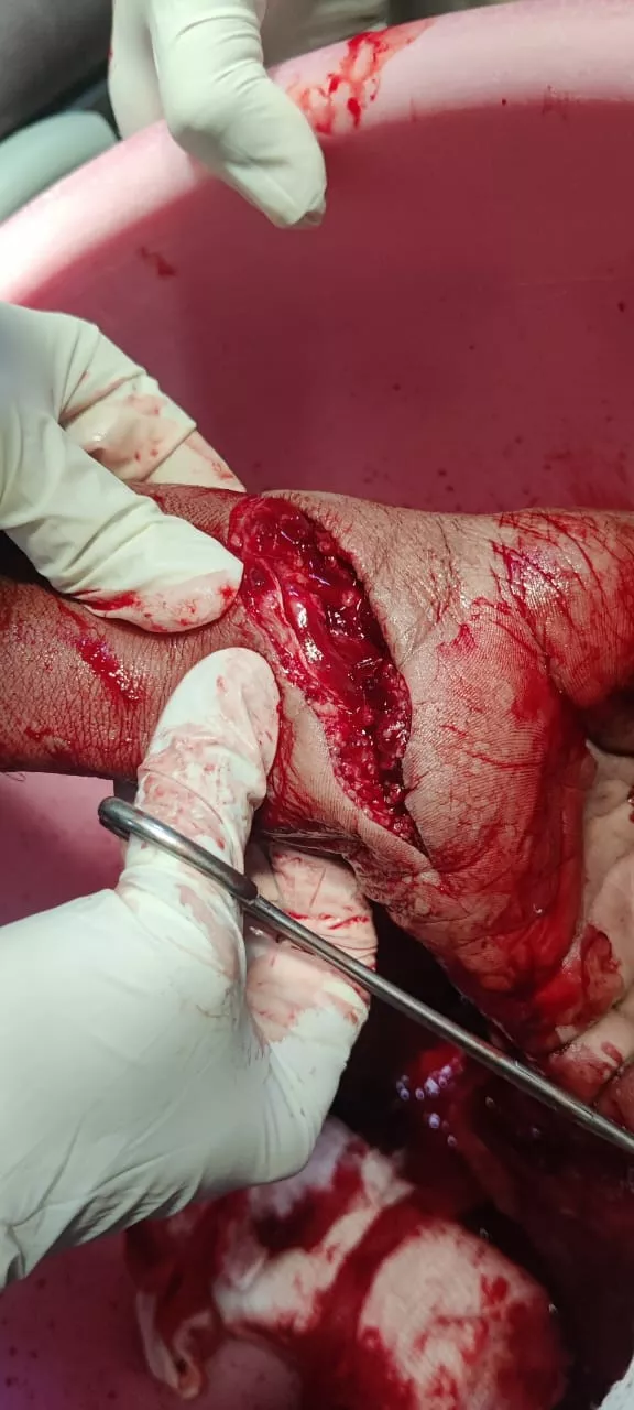 Combined Vascular, Tendon, and Nerve Injury of the Wrist: A Case Report 1