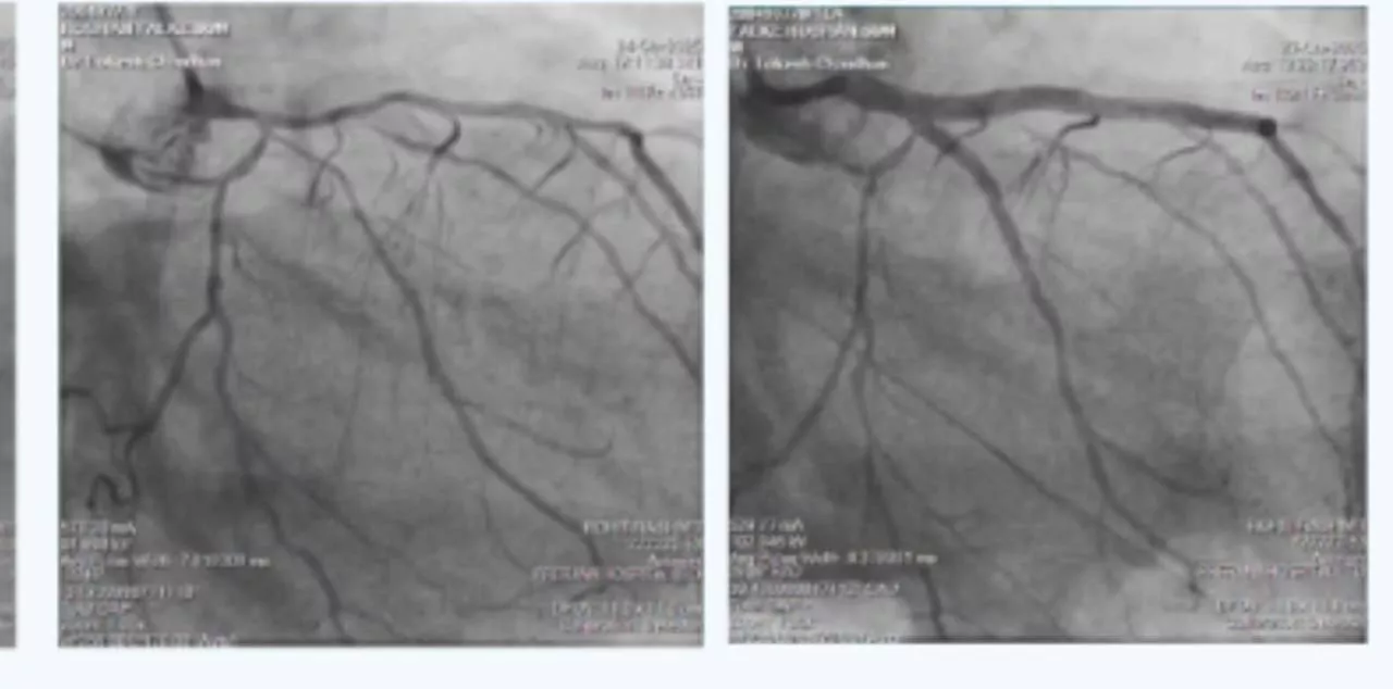 Acute Coronary Syndrome in a Patient with Multiple Comorbidities 1