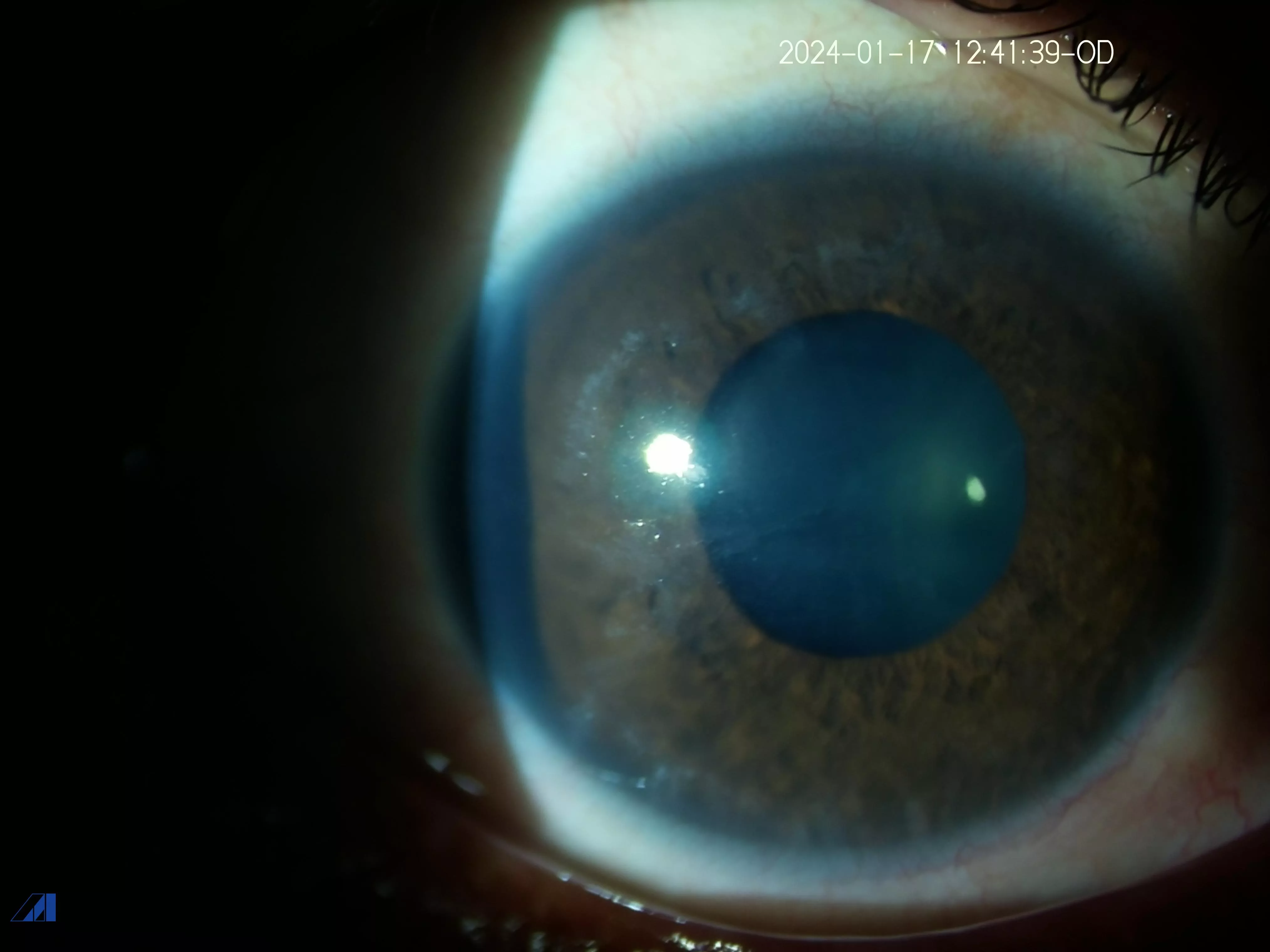 Migratory Corneal 2