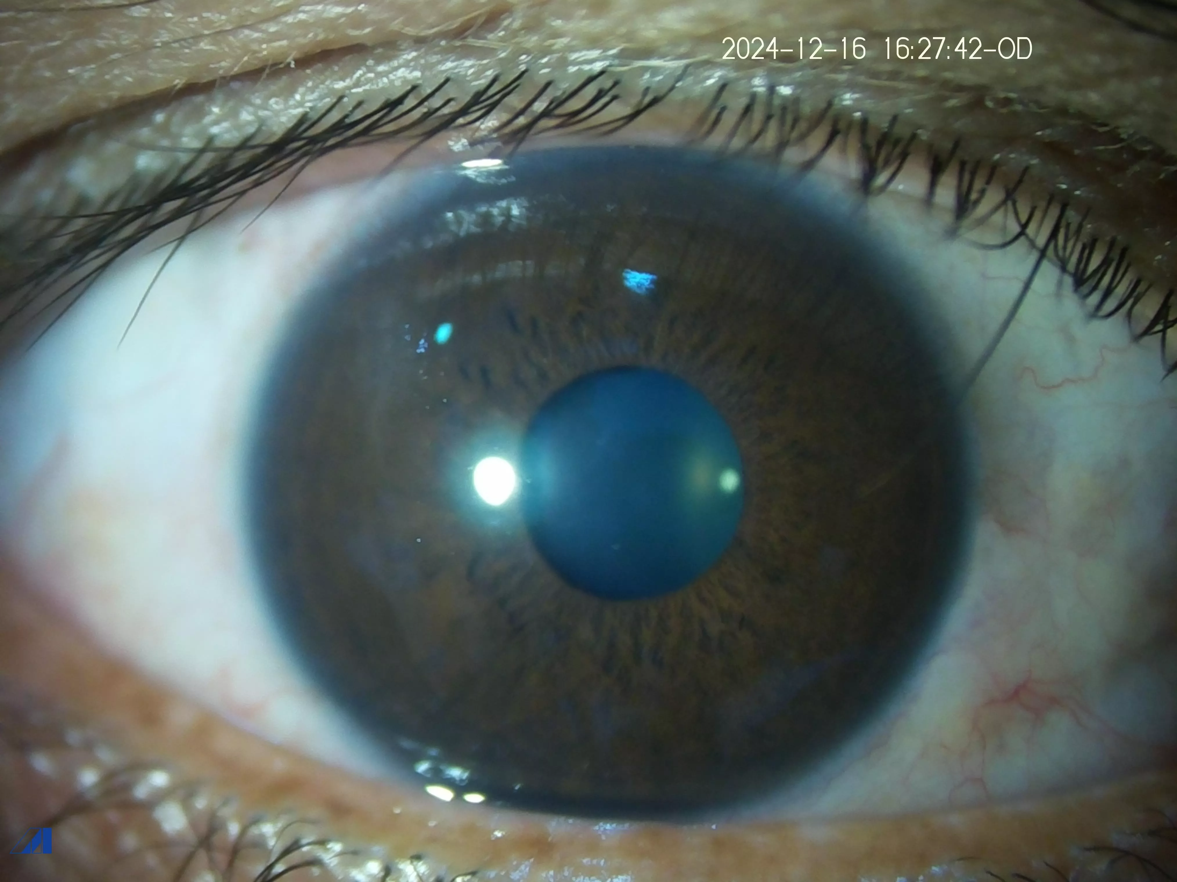 Migratory Corneal 4