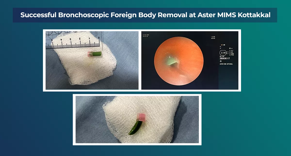 Successful Bronchoscopic Foreign Body Removal at Aster MIMS Kottakkal