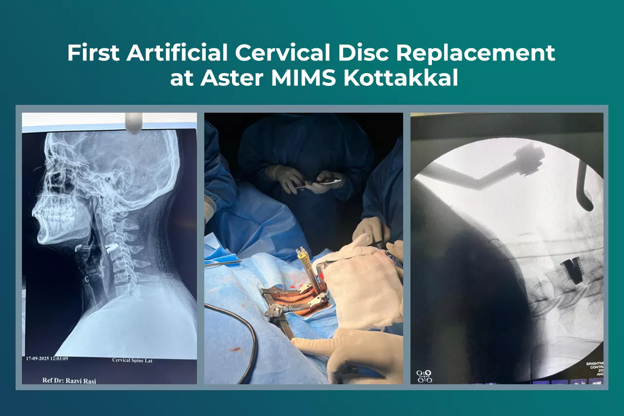 Patient Success Story | Advanced Spine Care Aster MIMS Hospital, Kottakkal, continues to advance in delivering cutting-edge spine care with the successful completion of its first artificial cervical disc replacement surgery. Patient Overview A 23-year-old IT professional, Mr. Akshay Sagar, presented with: Persistent neck pain Pain radiating to the right upper limb Difficulty in daily activities affecting work performance Following clinical evaluation and imaging, he was diagnosed with C3–C4 Intervertebra