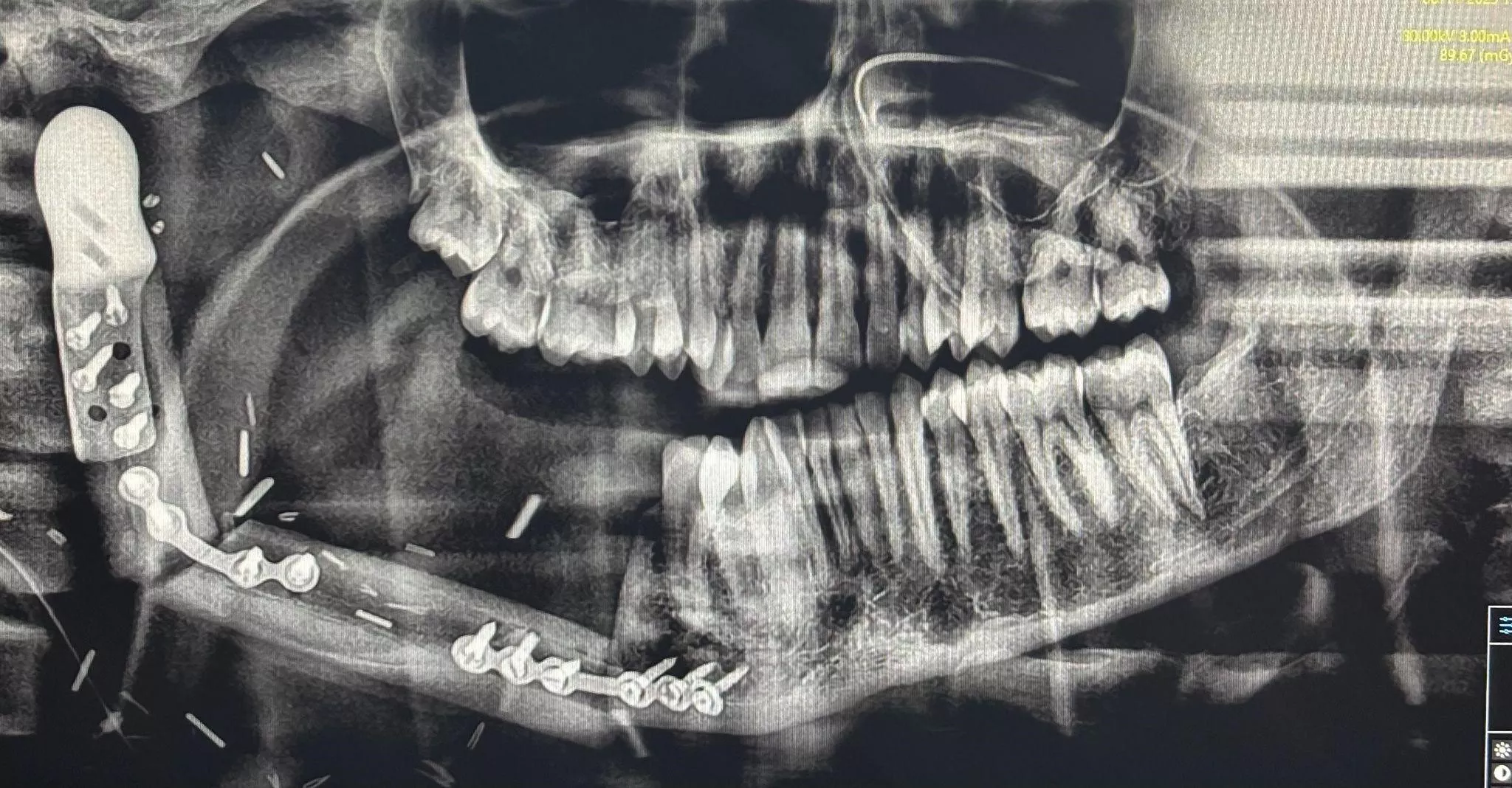 Free fibula flap