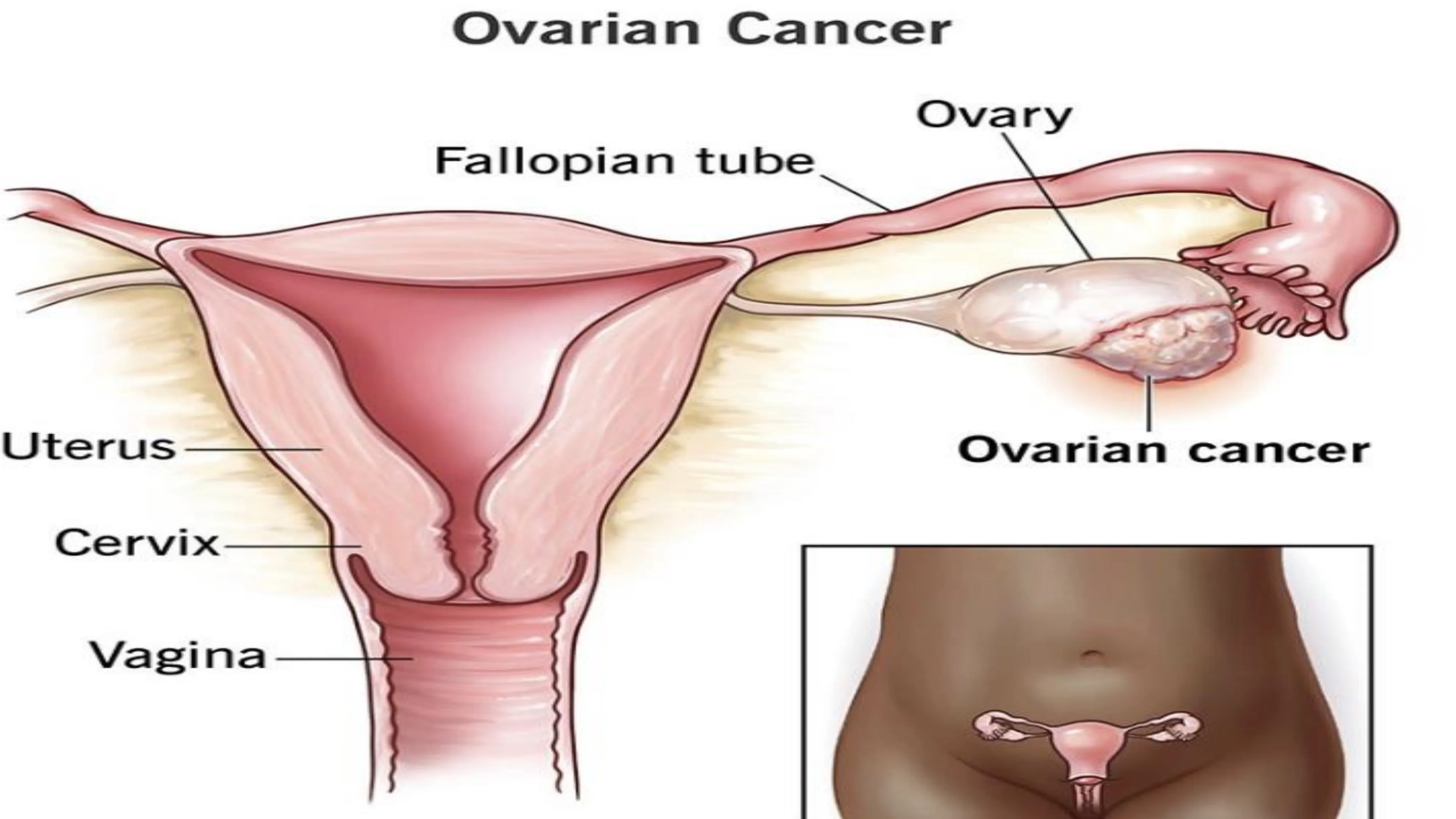 Ovarian image