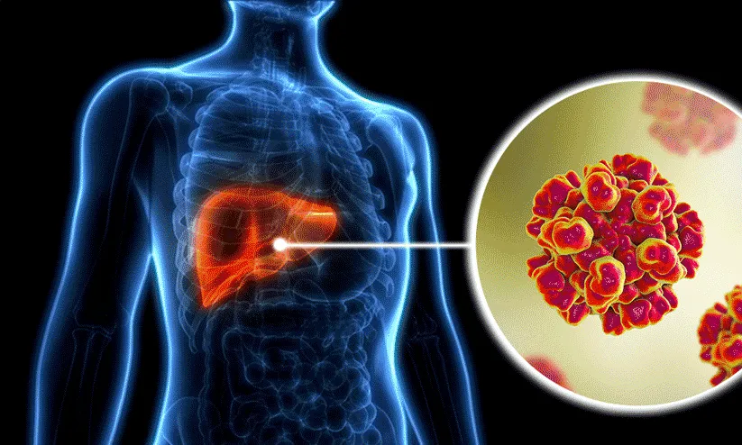 Hepatitis Liver  Disease
