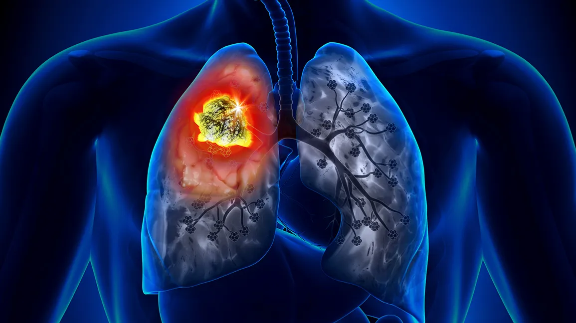 copd Lung cancer