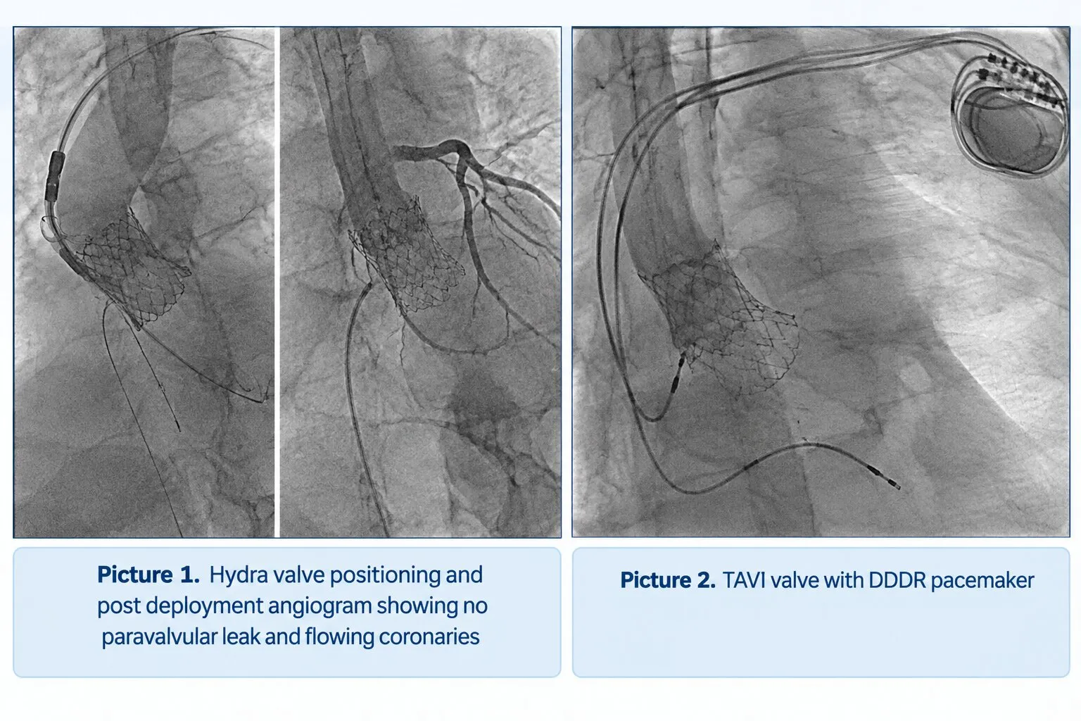 tavi case sept 26