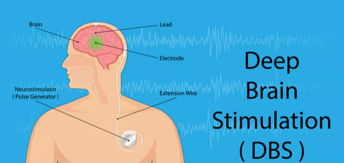 dbs-treatment-bangalore-india