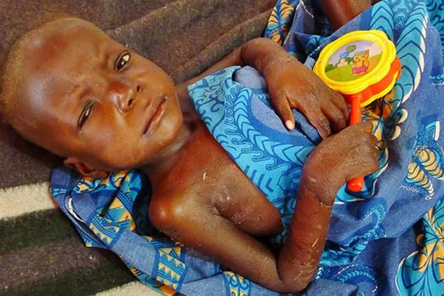 Malnutrition640x627px.jpg