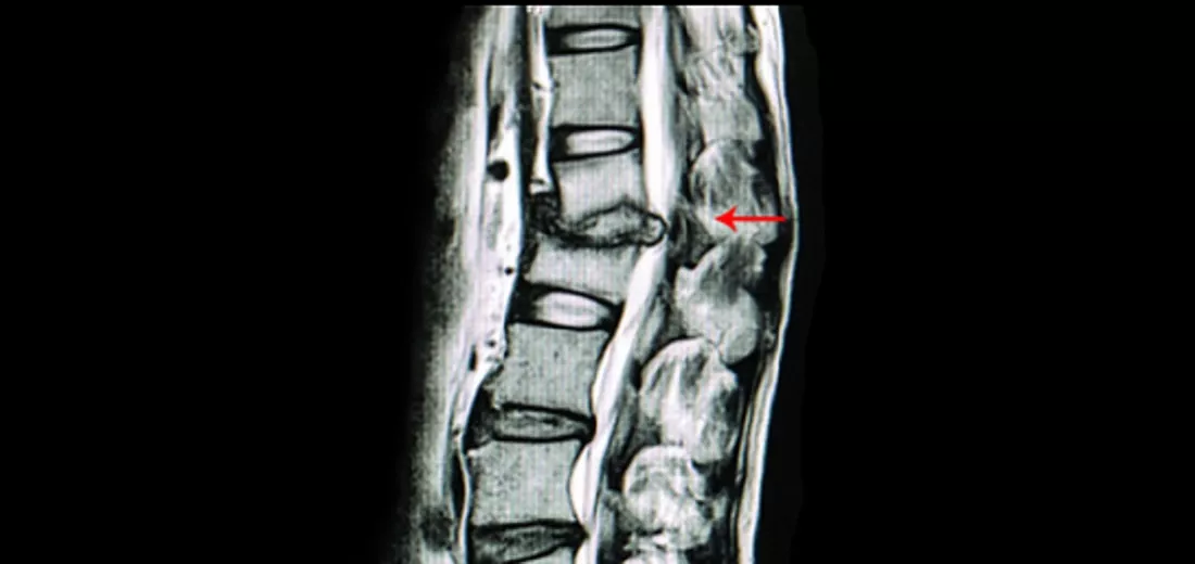 spine-surgery-treatment-bangalore