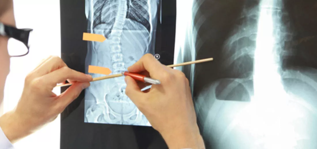 Scoliosis Causes, Symptoms and Treatment