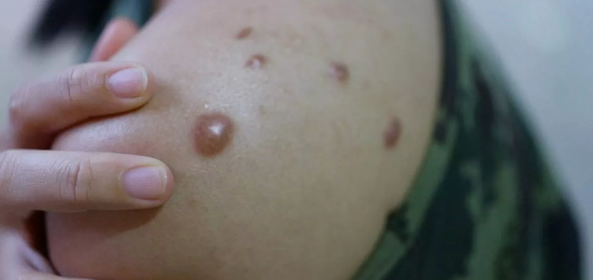 What's monkeypox?' Woman with 'insane rash' turned away for testing