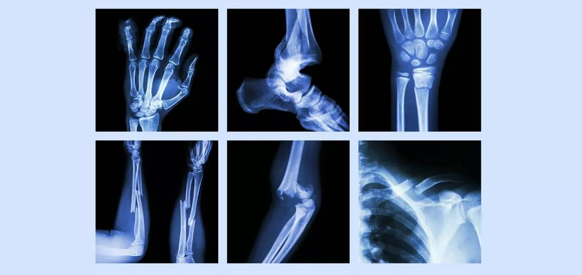 types of bone fracture