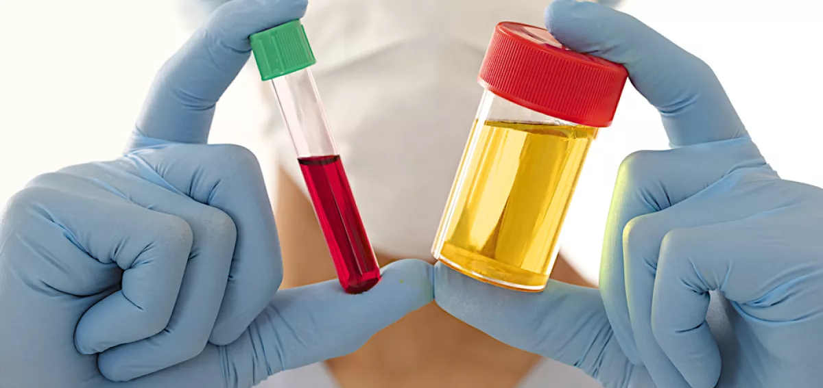 Haematuria (Blood in urine): Symptoms, Causes, and Treatment