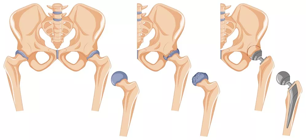 Neglected hip dislocation in Adult-Rare Case