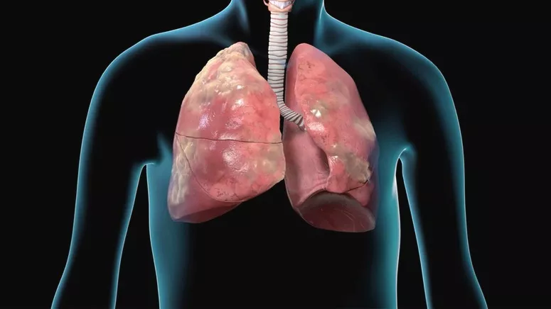 COPD Symptoms
